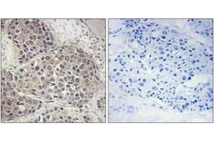 Immunohistochemistry analysis of paraffin-embedded human breast carcinoma, using p70 S6 Kinase (Phospho-Ser424) Antibody.
