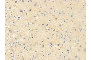 ABIN6260578 and ABIN6278244 at 1/100 staining human hepatocellular carcinoma by IHC-P.