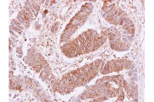 IHC-P Image VPS35 antibody [C3], C-term detects VPS35 protein at cytoplasm and membrane on human colon carcinoma by immunohistochemical analysis. (VPS35 anticorps  (C-Term))