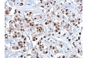 IHC-P Image FOXA1 antibody detects FOXA1 protein at nucleus on human breast carcinoma by immunohistochemical analysis. (FOXA1 anticorps  (C-Term))