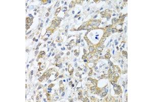 Immunohistochemistry of paraffin-embedded human gastric cancer using TICAM1 antibody. (TICAM1 anticorps  (AA 20-200))