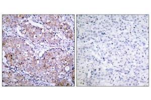Immunohistochemical analysis of paraffin-embedded human breast carcinoma tissue using EGFR(Phospho-Ser1070) Antibody(left) or the same antibody preincubated with blocking peptide(right). (EGFR anticorps  (pSer1070))