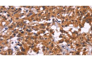 Immunohistochemistry of paraffin-embedded Human thyroid cancer tissue using MSH4 Polyclonal Antibody at dilution 1:30 (MSH4 anticorps)
