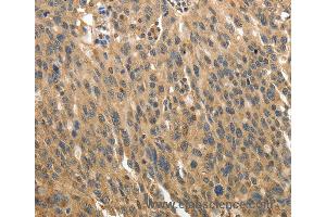 Immunohistochemistry of Human ovarian cancer using MSN Polyclonal Antibody at dilution of 1:30 (Moesin anticorps)