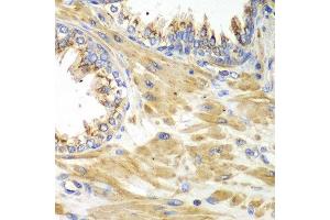 Immunohistochemistry of paraffin-embedded human prostate using PICK1 antibody at dilution of 1:100 (x40 lens). (PICK1 anticorps)