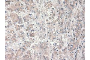 Immunohistochemical staining of paraffin-embedded Carcinoma of liver tissue using anti-PROM2mouse monoclonal antibody. (Prominin 2 anticorps)