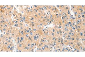Immunohistochemistry of paraffin-embedded Human liver cancer using RPN1 Polyclonal Antibody at dilution of 1:30