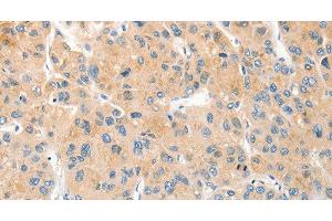 Immunohistochemistry of paraffin-embedded Human liver cancer using RPN1 Polyclonal Antibody at dilution of 1:30 (RPN1 anticorps)