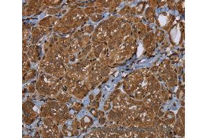 Immunohistochemistry of Human thyroid cancer using HSD17B4 Polyclonal Antibody at dilution of 1:30 (HSD17B4 anticorps)