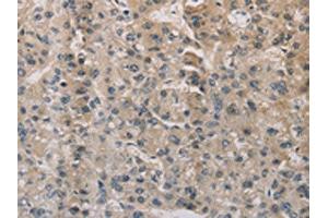 The image on the left is immunohistochemistry of paraffin-embedded Human liver cancer tissue using ABIN7129403(ESRRG Antibody) at dilution 1/30, on the right is treated with fusion protein.