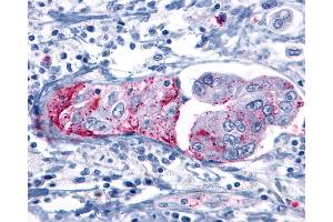 Anti-GRM8 / MGLUR8 antibody IHC of human Pancreas, Carcinoma.
