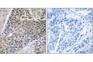 Immunohistochemistry analysis of paraffin-embedded human lung carcinoma tissue, using MRPS7 Antibody. (MRPS7 anticorps  (AA 91-140))