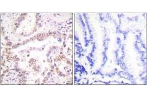 Immunohistochemistry analysis of paraffin-embedded human lung carcinoma tissue, using SKP2/p45 Antibody. (SKP2 anticorps  (AA 366-415))