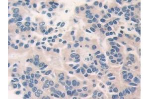 Detection of CECR1 in Human Prostate cancer Tissue using Polyclonal Antibody to Cat Eye Syndrome Chromosome Region, Candidate 1 (CECR1) (CECR1 anticorps  (AA 30-511))