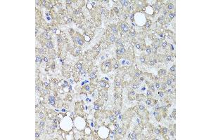 Immunohistochemistry of paraffin-embedded human liver injury using MUC16 antibody at dilution of 1:100 (x40 lens). (MUC16 anticorps)