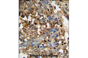 DMP4 antibody immunohistochemistry analysis in formalin fixed and paraffin embedded human breast carcinoma followed by peroxidase conjugation of the secondary antibody and DAB staining. (FAM20C anticorps  (C-Term))