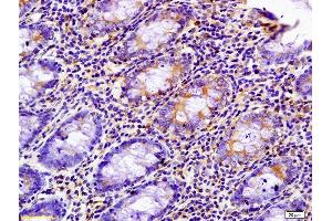 Formalin-fixed and paraffin embedded human colon carcinoma labeled with Anti-phospho-PRKCZ(Thr500) Polyclonal Antibody, Unconjugated (ABIN741240) at 1:200 followed by conjugation to the secondary antibody and DAB staining
