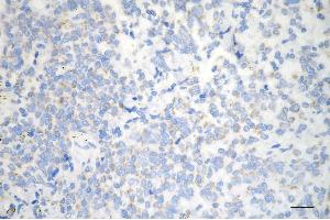 Immunohistochemistry was performed on paraffin-embedded human breast carcinoma using HDHD5 antibody (ABIN7798836), 1:200). (Recombinant Haloacid Dehalogenase-Like Hydrolase Domain-Containing 5 (HDHD5) anticorps)