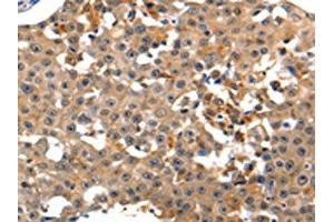 The image on the left is immunohistochemistry of paraffin-embedded Human breast cancer tissue using ABIN7190883(GRM1 Antibody) at dilution 1/15, on the right is treated with synthetic peptide. (Metabotropic Glutamate Receptor 1 anticorps)