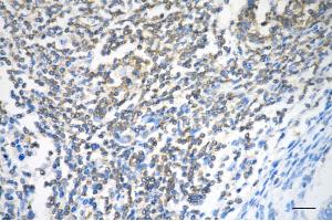 Immunohistochemistry was performed on paraffin-embedded human sigmoid colon carcinoma using CLPP antibody (ABIN7798100), 1:200).