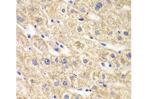 Immunohistochemistry of paraffin-embedded Human liver damage using ACADS Polyclonal Antibody at dilution of 1:100 (40x lens). (ACADS anticorps)