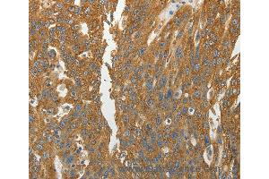 Immunohistochemistry of Human ovarian cancer using RPLP0 Polyclonal Antibody at dilution of 1:40 (RPLP0 anticorps)