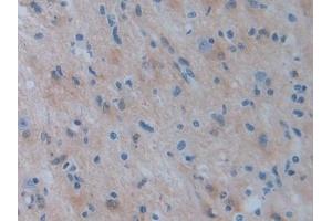 Detection of PSAT1 in Human Glioma Tissue using Polyclonal Antibody to Phosphoserine Aminotransferase 1 (PSAT1)