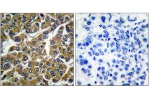 Immunohistochemistry analysis of paraffin-embedded human breast carcinoma tissue, using MMP-3 Antibody.