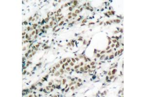 Immunohistochemistry of paraffin-embedded human breast carcinoma tissue, using Phospho-FOXO4-S197 antibody (ABIN2987524). (FOXO4 anticorps  (pSer197))