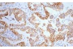 Immunohistochemistry of paraffin-embedded Human lung cancer tissue using CK-7 Monoclonal Antibody at dilution of 1:200. (Cytokeratin 7 anticorps)