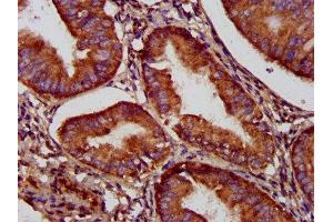 IHC image of ABIN7160839 diluted at 1:500 and staining in paraffin-embedded human endometrial cancer performed on a Leica BondTM system.