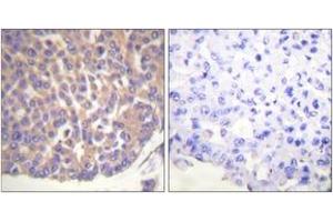 Immunohistochemistry analysis of paraffin-embedded human breast carcinoma tissue, using Filamin A (Ab-2152) Antibody. (Filamin A anticorps  (AA 2121-2170))