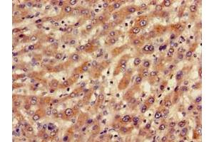 Immunohistochemistry of paraffin-embedded human liver cancer using ABIN7145235 at dilution of 1:100 (BBS1 anticorps  (AA 435-552))