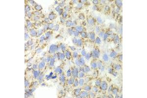 Immunohistochemistry of paraffin-embedded human esophageal cancer using ALDH4A1 antibody at dilution of 1:100 (x40 lens). (ALDH4A1 anticorps)