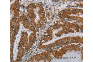 Immunohistochemistry of Human esophagus cancer using CSH1 Polyclonal Antibody at dilution of 1:40