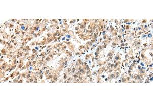 Immunohistochemistry of paraffin-embedded Human ovarian cancer tissue using S100A16 Polyclonal Antibody at dilution of 1:25(x200) (S100A16 anticorps)