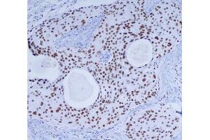 Immunohistochemical analysis of paraffin-embedded Breast cancer using DNA-PKcs mouse mAb (1/200 dilution).