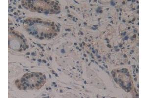 Detection of ENO3 in Human Stomach cancer Tissue using Polyclonal Antibody to Enolase 3 (ENO3)