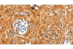 Immunohistochemistry of paraffin-embedded Human cervical cancer tissue using NCOR1 Polyclonal Antibody at dilution 1:100 (NCOR1 anticorps)