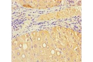 Immunohistochemistry of paraffin-embedded human liver tissue using ABIN7175549 at dilution of 1:100 (VMO1 anticorps  (AA 25-202))