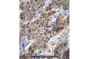TGFB1 Antibody (N-term) immunohistochemistry analysis in formalin fixed and paraffin embedded human breast carcinoma followed by peroxidase conjugation of the secondary antibody and DAB staining. (TGFB1 anticorps  (N-Term))