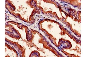 Immunohistochemistry of paraffin-embedded human prostate cancer using ABIN7161940 at dilution of 1:100 (NXF5 anticorps  (AA 1-200))