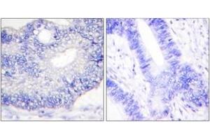 Immunohistochemistry analysis of paraffin-embedded human colon carcinoma tissue, using TGF alpha Antibody. (TGFA anticorps  (AA 111-160))