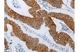 The image on the left is immunohistochemistry of paraffin-embedded Human colon cancer tissue using ABIN7192809(TMEM8B Antibody) at dilution 1/15, on the right is treated with synthetic peptide. (TMEM8B anticorps)