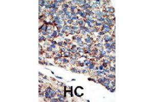 Formalin-fixed and paraffin-embedded human hepatocellular carcinoma tissue reacted with PIK3C2G polyclonal antibody  , which was peroxidase-conjugated to the secondary antibody, followed by AEC staining. (PIK3C2G anticorps  (N-Term))