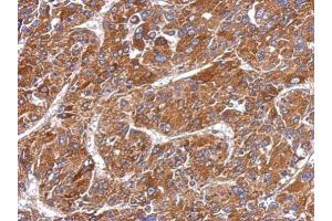IHC-P Image Immunohistochemical analysis of paraffin-embedded human hepatoma, using MMP8, antibody at 1:500 dilution. (MMP8 anticorps)