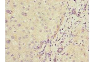 Immunohistochemistry of paraffin-embedded human liver cancer using ABIN7148298 at dilution of 1:100 (COMMD1 anticorps  (AA 1-190))