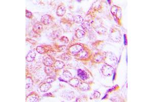 Immunohistochemical analysis of BMP5 staining in human lung cancer formalin fixed paraffin embedded tissue section.