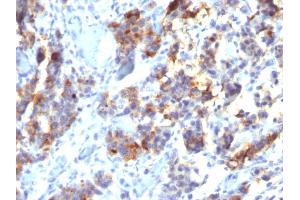 Formalin-fixed, paraffin-embedded human Gastric Carcinoma stained with MUC5AC Mouse Monoclonal Antibody (45M1). (MUC5AC anticorps)
