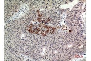 Immunohistochemistry (IHC) analysis of paraffin-embedded Human Breast Cancer, antibody was diluted at 1:100. (STING/TMEM173 anticorps  (C-Term))